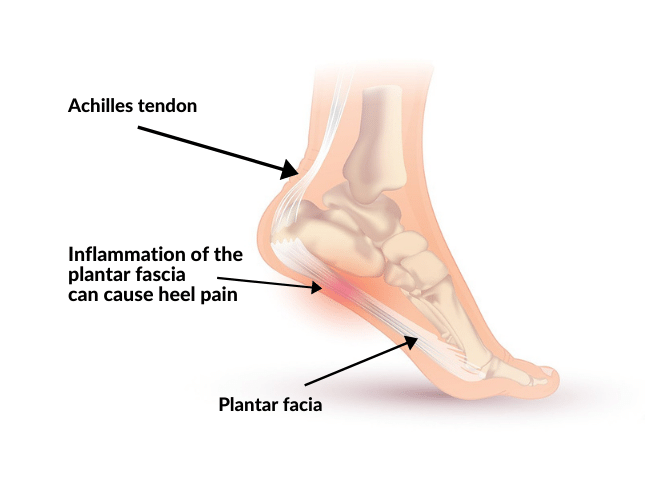 foot conditions plantar fasciitis